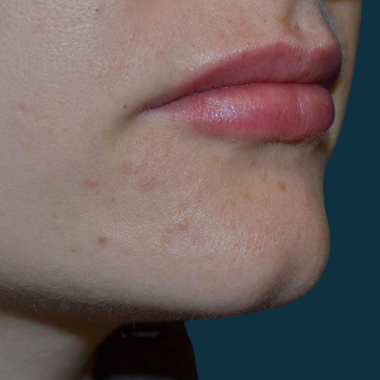 After Image: Lip Filler - right-front-oblique